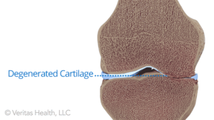 cartilage-degeneration-knee-oa